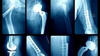 Röntgenaufnahmen verschiedener Implantate